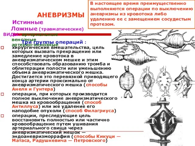 АНЕВРИЗМЫ Истинные Ложные (травматические) ВИДЫ: артериальные венозные артерио-венозные Три группы операций :