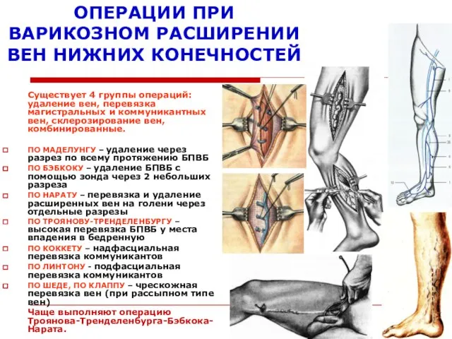 ОПЕРАЦИИ ПРИ ВАРИКОЗНОМ РАСШИРЕНИИ ВЕН НИЖНИХ КОНЕЧНОСТЕЙ Существует 4 группы операций: удаление