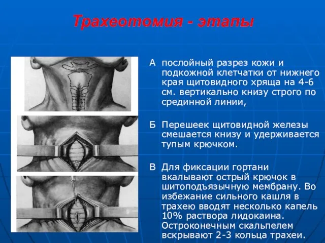 Трахеотомия - этапы А послойный разрез кожи и подкожной клетчатки от нижнего