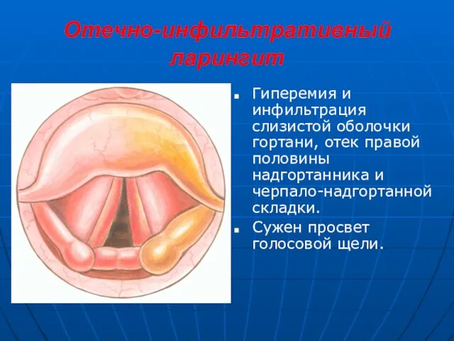 Отечно-инфильтративный ларингит Гиперемия и инфильтрация слизистой оболочки гортани, отек правой половины надгортанника