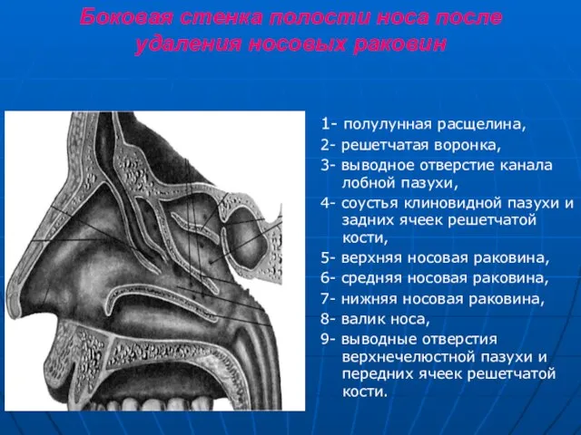 Боковая стенка полости носа после удаления носовых раковин 1- полулунная расщелина, 2-