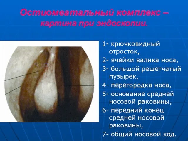 Остиомеатальный комплекс – картина при эндоскопии. 1- крючковидный отросток, 2- ячейки валика