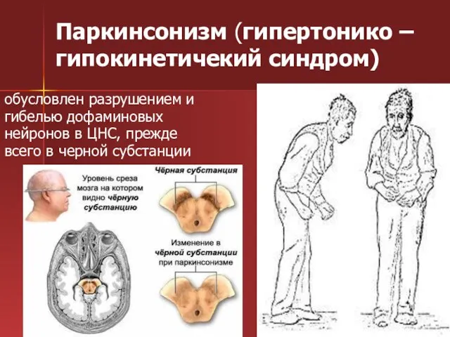 Паркинсонизм (гипертонико – гипокинетичекий синдром) обусловлен разрушением и гибелью дофаминовых нейронов в