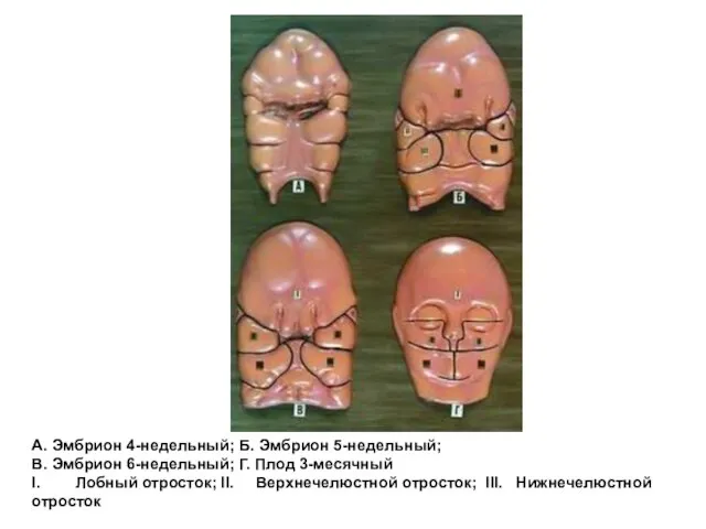 А. Эмбрион 4-недельный; Б. Эмбрион 5-недельный; В. Эмбрион 6-недельный; Г. Плод 3-месячный