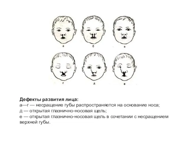 Дефекты развития лица: а—г — несращение губы распространяется на основание носа; д
