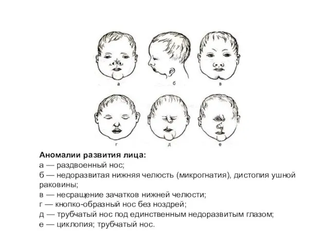 Аномалии развития лица: а — раздвоенный нос; б — недоразвитая нижняя челюсть