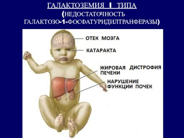 ГАЛАКТОЗЕМИЯ I ТИПА (НЕДОСТАТОЧНОСТЬ ГАЛАКТОЗО-1-ФОСФАТУРИДИЛТРАНФЕРАЗЫ)