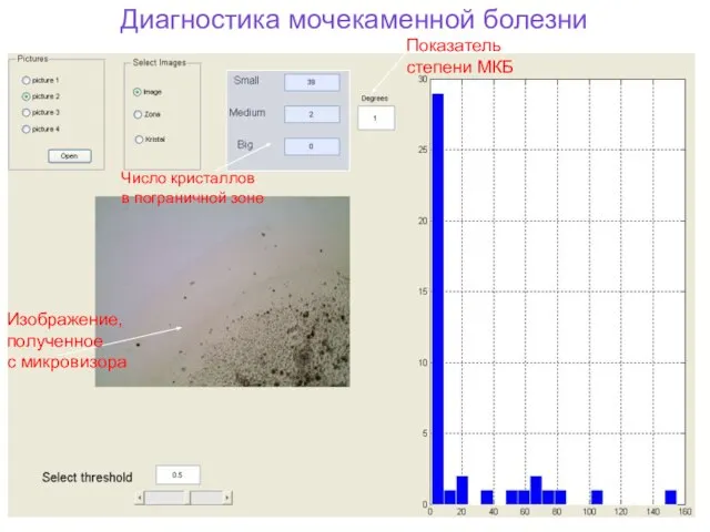 Изображение, полученное с микровизора Показатель степени МКБ Число кристаллов в пограничной зоне Диагностика мочекаменной болезни