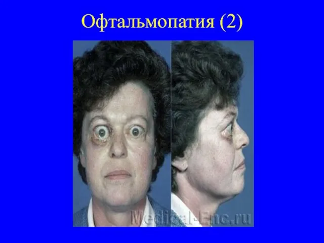 Офтальмопатия (2)
