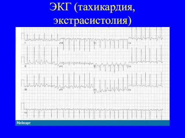 ЭКГ (тахикардия, экстрасистолия)