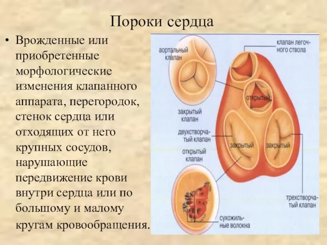 Пороки сердца Врожденные или приобретенные морфологические изменения клапанного аппарата, перегородок, стенок сердца