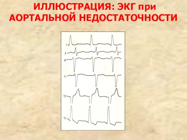 ИЛЛЮСТРАЦИЯ: ЭКГ при АОРТАЛЬНОЙ НЕДОСТАТОЧНОСТИ