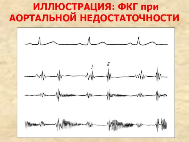 ИЛЛЮСТРАЦИЯ: ФКГ при АОРТАЛЬНОЙ НЕДОСТАТОЧНОСТИ