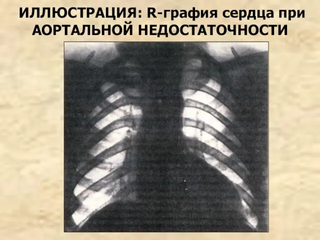 ИЛЛЮСТРАЦИЯ: R-графия сердца при АОРТАЛЬНОЙ НЕДОСТАТОЧНОСТИ