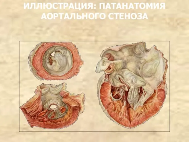 ИЛЛЮСТРАЦИЯ: ПАТАНАТОМИЯ АОРТАЛЬНОГО СТЕНОЗА