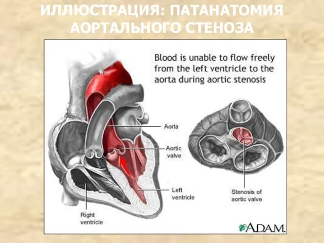 ИЛЛЮСТРАЦИЯ: ПАТАНАТОМИЯ АОРТАЛЬНОГО СТЕНОЗА