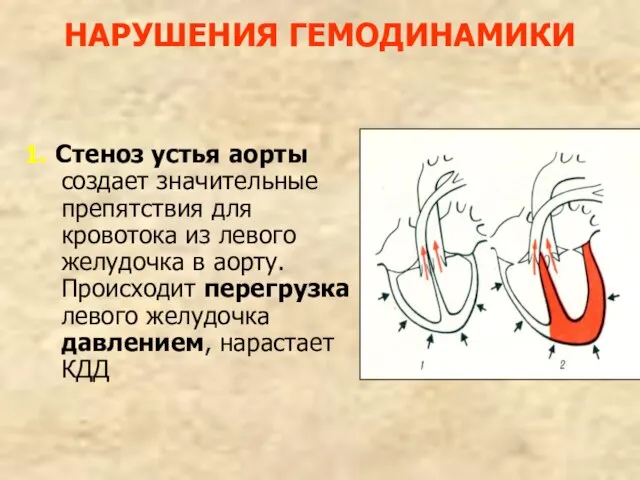 НАРУШЕНИЯ ГЕМОДИНАМИКИ 1. Стеноз устья аорты создает значительные препятствия для кровотока из