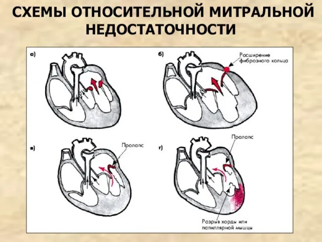 СХЕМЫ ОТНОСИТЕЛЬНОЙ МИТРАЛЬНОЙ НЕДОСТАТОЧНОСТИ