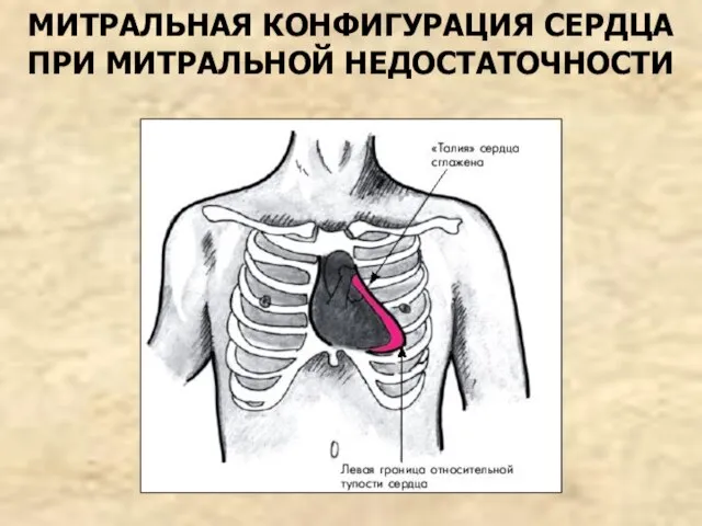 МИТРАЛЬНАЯ КОНФИГУРАЦИЯ СЕРДЦА ПРИ МИТРАЛЬНОЙ НЕДОСТАТОЧНОСТИ