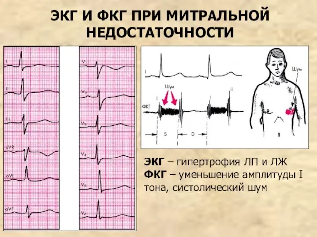 ЭКГ И ФКГ ПРИ МИТРАЛЬНОЙ НЕДОСТАТОЧНОСТИ ЭКГ – гипертрофия ЛП и ЛЖ