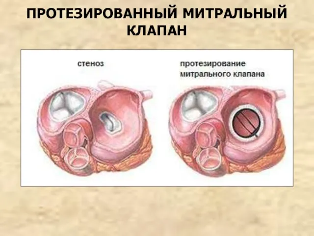 ПРОТЕЗИРОВАННЫЙ МИТРАЛЬНЫЙ КЛАПАН