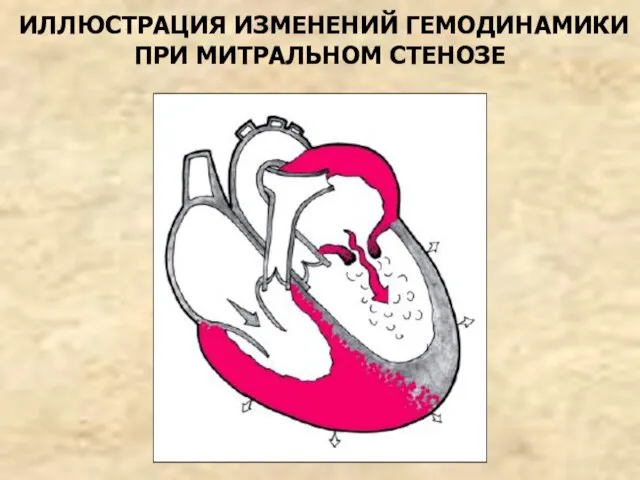 ИЛЛЮСТРАЦИЯ ИЗМЕНЕНИЙ ГЕМОДИНАМИКИ ПРИ МИТРАЛЬНОМ СТЕНОЗЕ