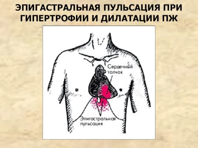 ЭПИГАСТРАЛЬНАЯ ПУЛЬСАЦИЯ ПРИ ГИПЕРТРОФИИ И ДИЛАТАЦИИ ПЖ