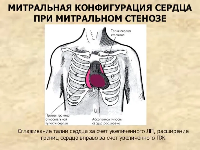 МИТРАЛЬНАЯ КОНФИГУРАЦИЯ СЕРДЦА ПРИ МИТРАЛЬНОМ СТЕНОЗЕ Сглаживание талии сердца за счет увеличенного