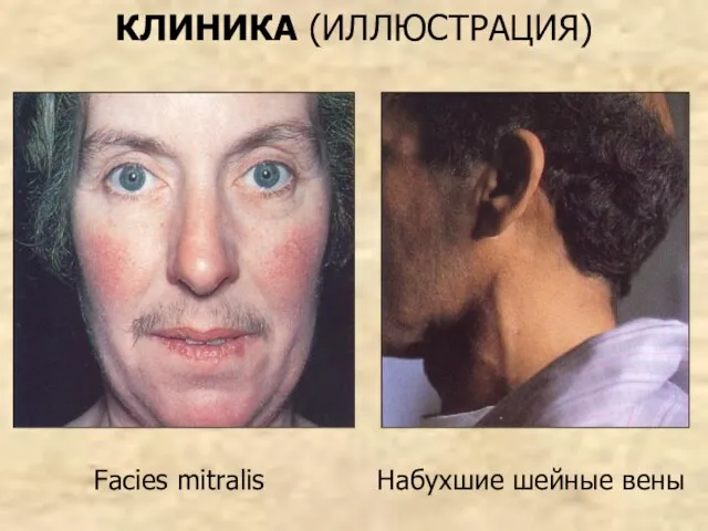 КЛИНИКА (ИЛЛЮСТРАЦИЯ) Facies mitralis Набухшие шейные вены