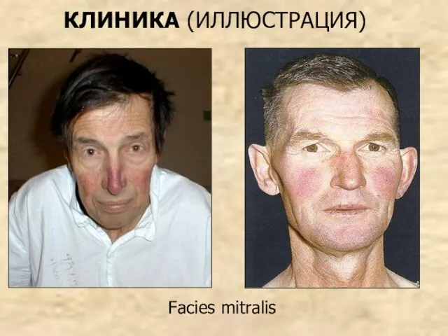 Facies mitralis КЛИНИКА (ИЛЛЮСТРАЦИЯ)