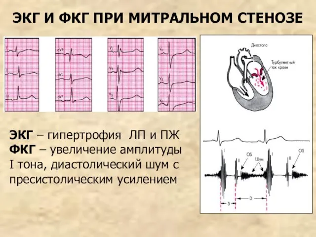 ЭКГ И ФКГ ПРИ МИТРАЛЬНОМ СТЕНОЗЕ ЭКГ – гипертрофия ЛП и ПЖ