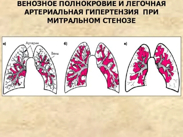 ВЕНОЗНОЕ ПОЛНОКРОВИЕ И ЛЕГОЧНАЯ АРТЕРИАЛЬНАЯ ГИПЕРТЕНЗИЯ ПРИ МИТРАЛЬНОМ СТЕНОЗЕ