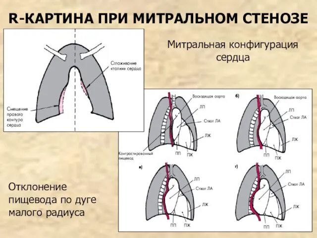 R-КАРТИНА ПРИ МИТРАЛЬНОМ СТЕНОЗЕ Митральная конфигурация сердца Отклонение пищевода по дуге малого радиуса