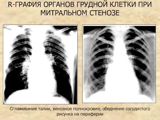 R-ГРАФИЯ ОРГАНОВ ГРУДНОЙ КЛЕТКИ ПРИ МИТРАЛЬНОМ СТЕНОЗЕ Сглаживание талии, венозное полнокровие, обеднение сосудистого рисунка на периферии