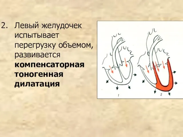 Левый желудочек испытывает перегрузку объемом, развивается компенсаторная тоногенная дилатация