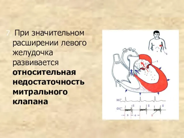 7. При значительном расширении левого желудочка развивается относительная недостаточность митрального клапана