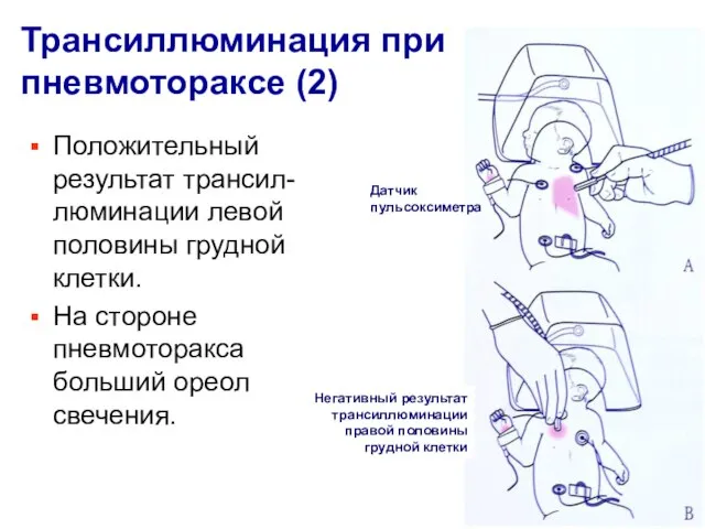 Трансиллюминация при пневмотораксе (2) Положительный результат трансил-люминации левой половины грудной клетки. На