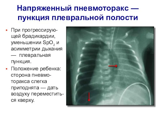 Напряженный пневмоторакс — пункция плевральной полости При прогрессирую-щей брадикардии, уменьшении SрO2 и