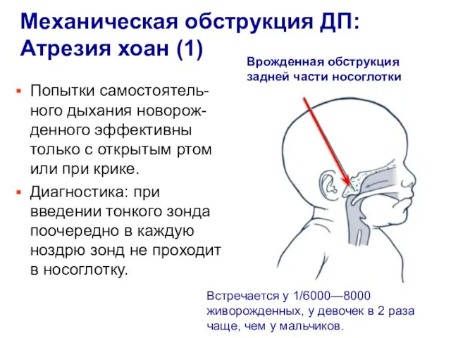 Механическая обструкция ДП: Атрезия хоан (1) Врожденная обструкция задней части носоглотки Встречается