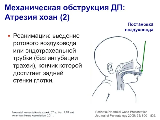 Механическая обструкция ДП: Атрезия хоан (2) Постановка воздуховода Perinatal/Neonatal Case Presentation Journal