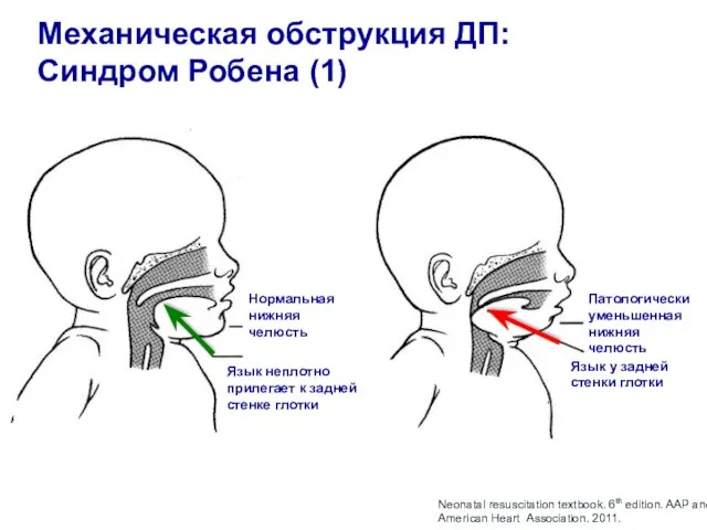 Механическая обструкция ДП: Синдром Робена (1) Нормальная нижняя челюсть Патологически уменьшенная нижняя