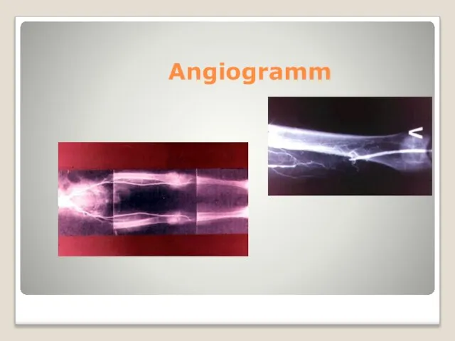 Angiogramm