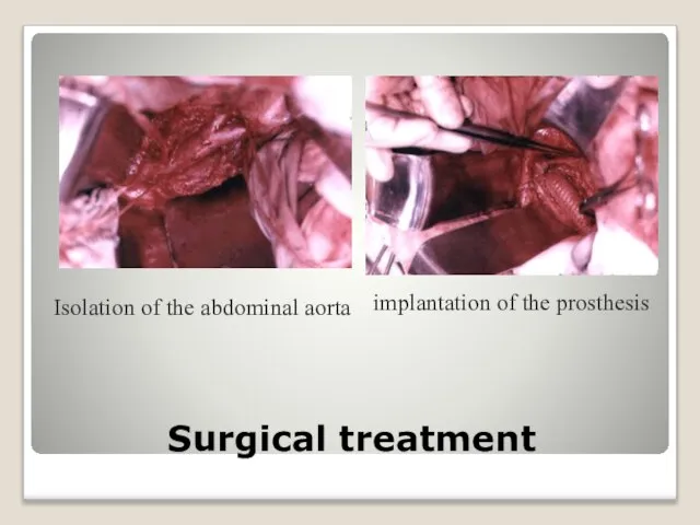 Surgical treatment Isolation of the abdominal aorta implantation of the prosthesis