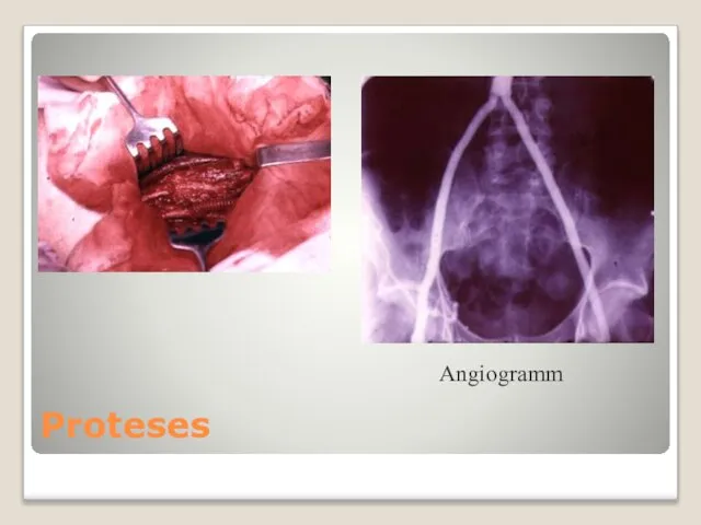 Proteses Angiogramm