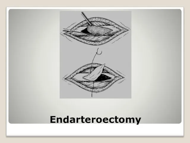 Endarteroectomy