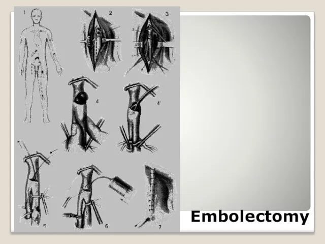 Embolectomy