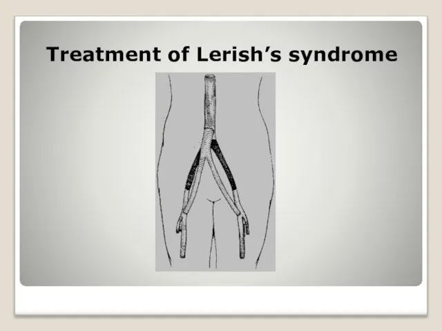 Treatment of Lerish’s syndrome