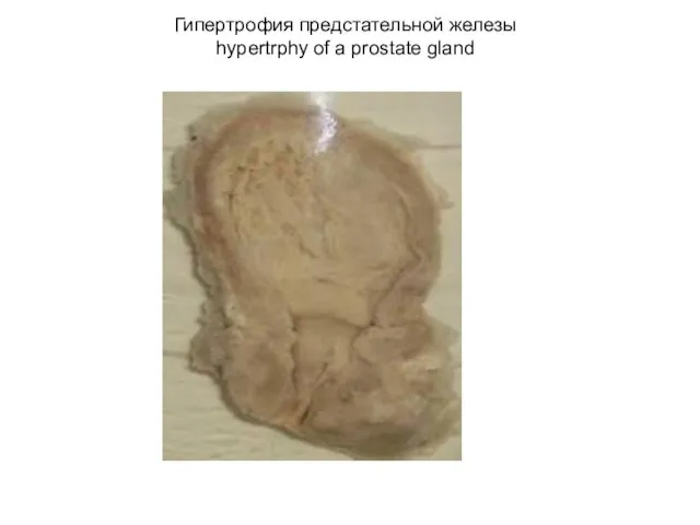 Гипертрофия предстательной железы hypertrphy of a prostate gland