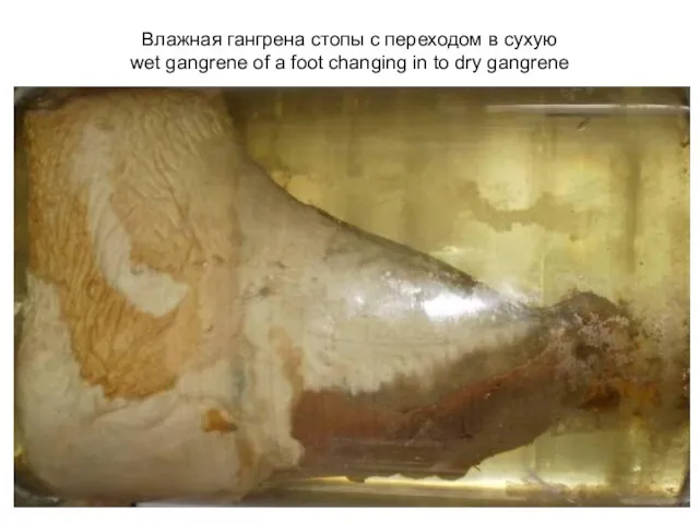 Влажная гангрена стопы с переходом в сухую wet gangrene of a foot