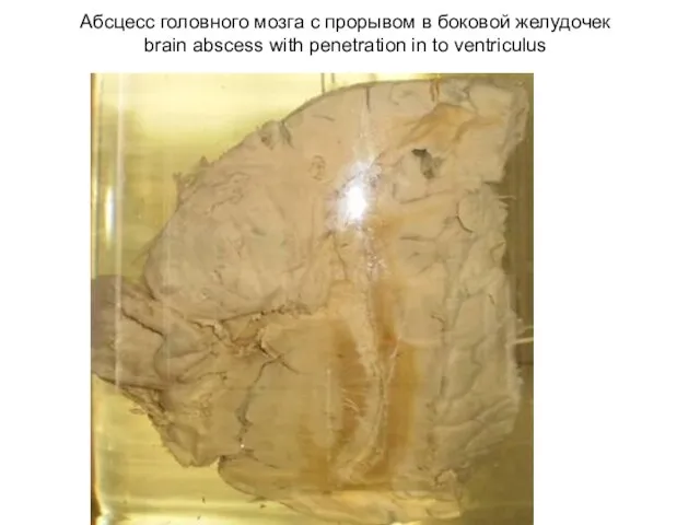 Абсцесс головного мозга с прорывом в боковой желудочек brain abscess with penetration in to ventriculus